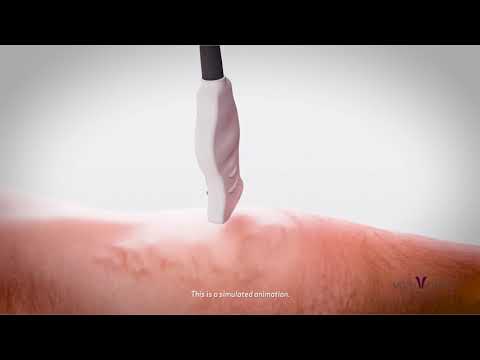 produse chuan cum se utilizeaza varicoza tratamentul glazurilor varicoase