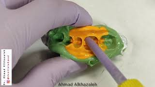 🎇 indirect class II restoration using resin composite! ✅ anatomy and contours on point!! ✅