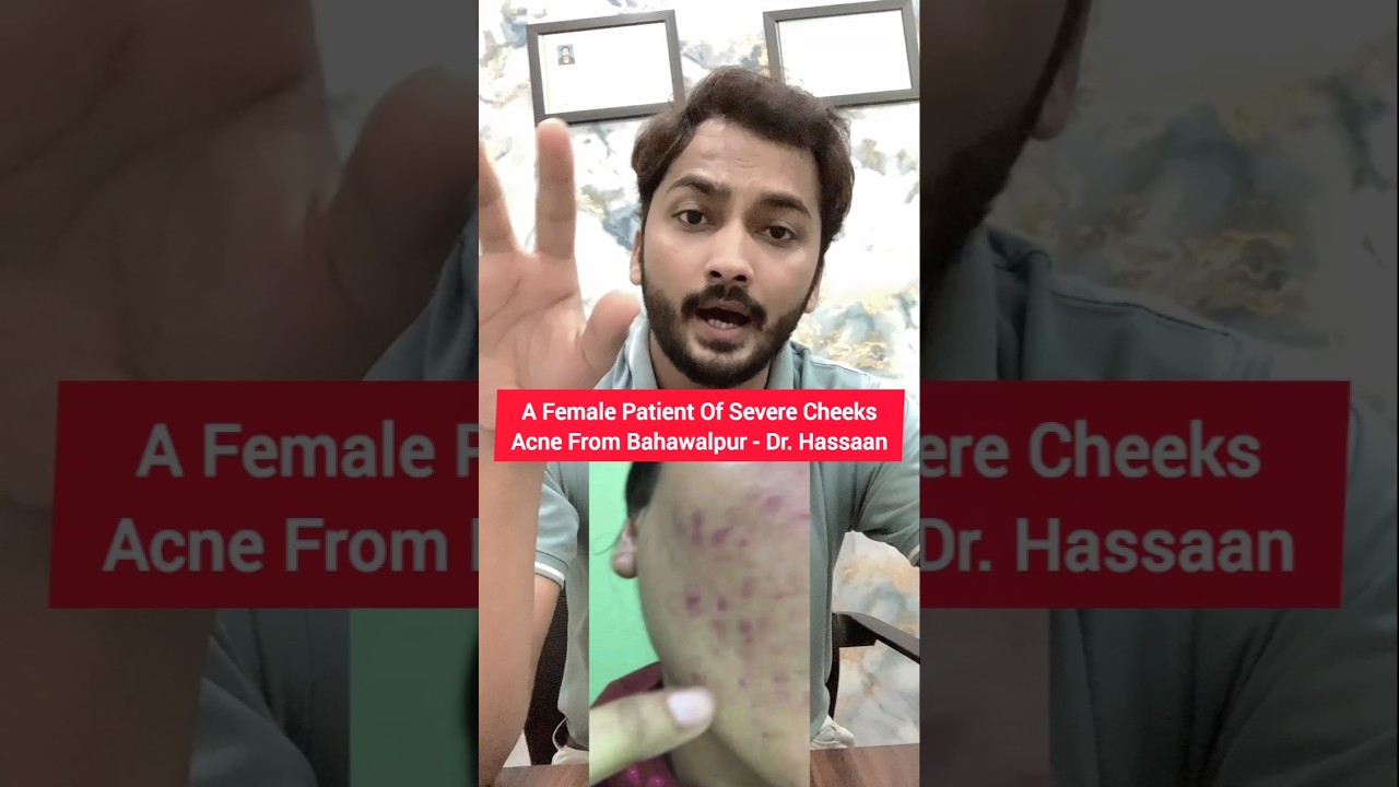 A Female Patient Of Severe Cheeks Acne From Bahawalpur