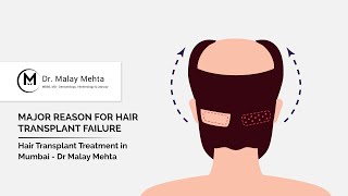 Avail The Top Quality Hair Transplant Treatment in Mumbai