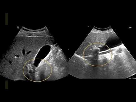 Focused Gallbladder Ultrasound