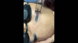 Laser Tattoo Removal (Full Process)
