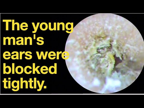 The young man's ears were blocked tightly.|ear wax removal | ear cleaning | ASMR | relaxation |relax