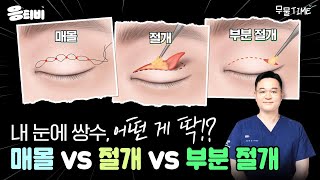 내게 어떤 게 딱❔ 매몰 vs 절개 vs 부분 절개‍｜눈성형｜윤현준 원장