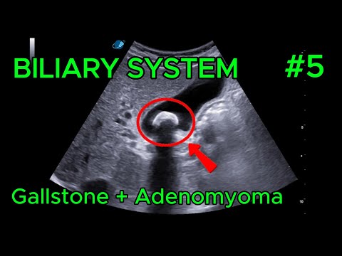 Gallstone (Large) + Adenomyoma  video preview