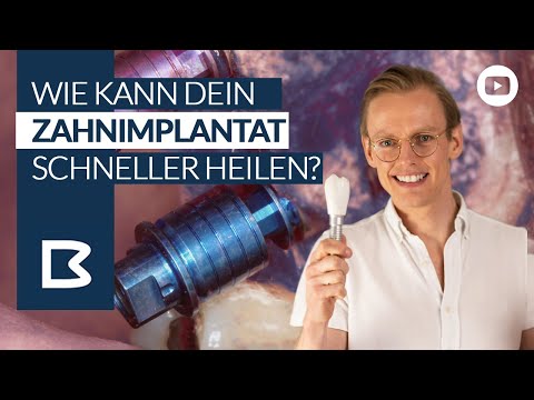 ZAHNIMPLANTATE & Heilung: Was kann ICH zur Beschleunigung der Heilung beitragen? Der GUIDE!