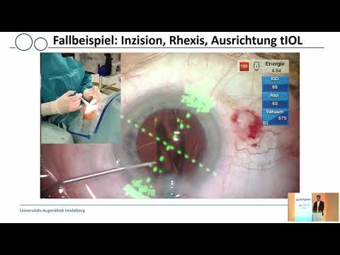 DGII 2021 - 3.04 Ramin Khoramnia - Image Guidance Systeme im intraoperativen Einsatz