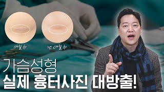최소절개? 가슴성형 흉터 진짜 작을까? 눈으로 확인하세요!