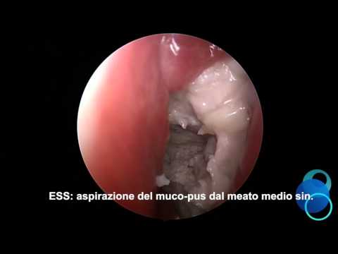 Il tutore sulla caviglia Kazan Come è epicondilite dellarticolazione del gomito