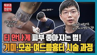 요즘 핫한! 실펌엑스 2탄! 기미, 모공, 여드름흉터 한번에 해결하기!