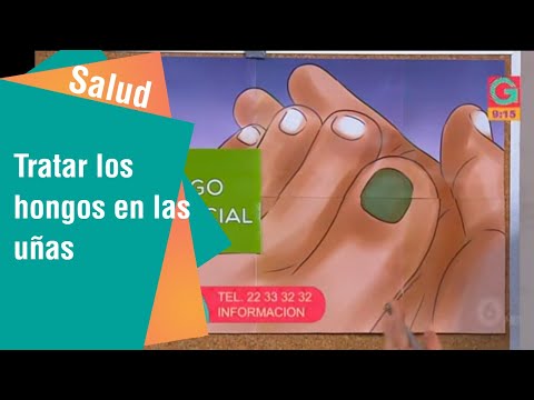 El hongo sobre las uñas en las manos que hacer Disgidrotichesky el hongo de los pie el tratamiento los preparados barato pero eficaz
