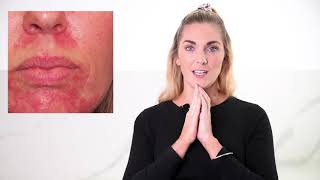 How To Treat Skin Redness | Rosacea - it
