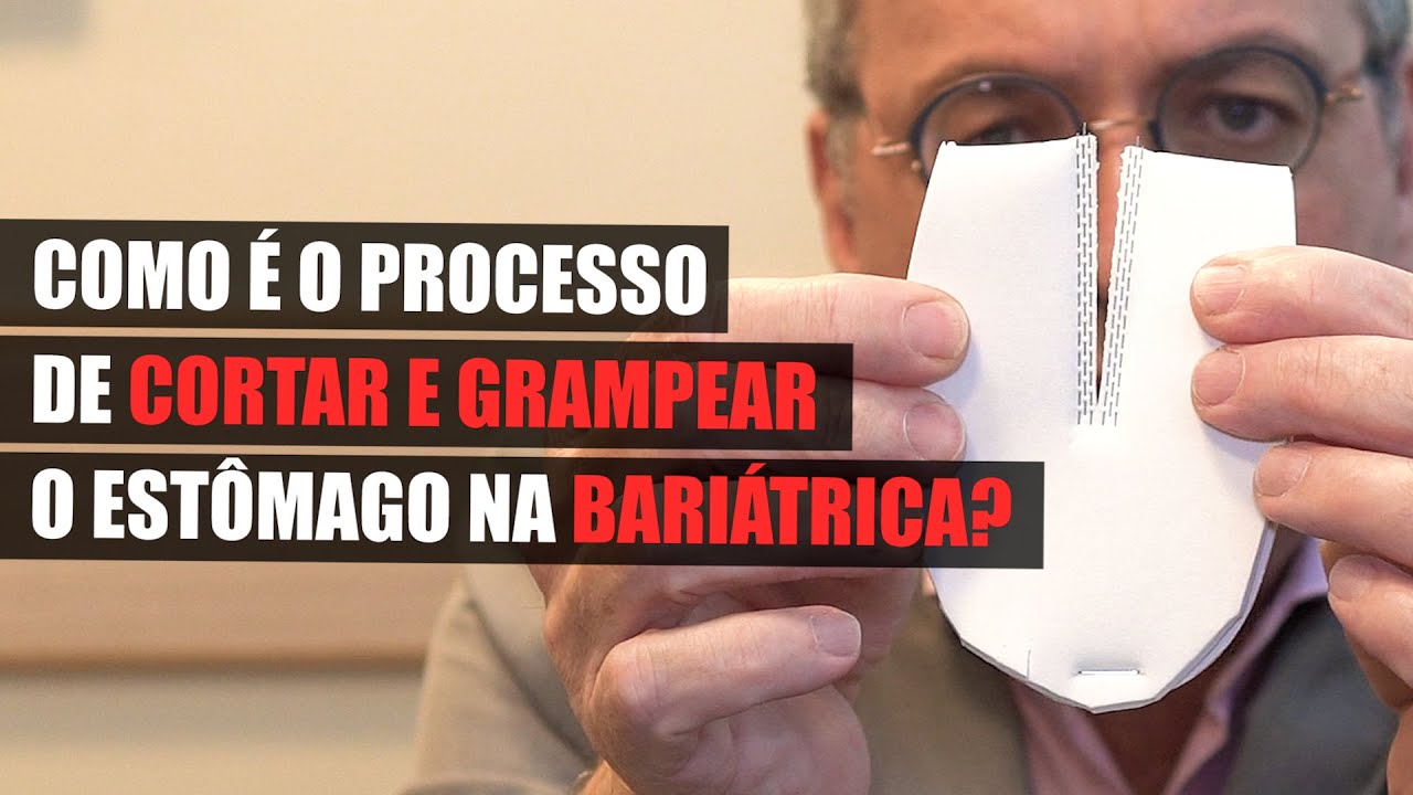 Cortar e grampear o estômago na bariátrica: como é na prática?
