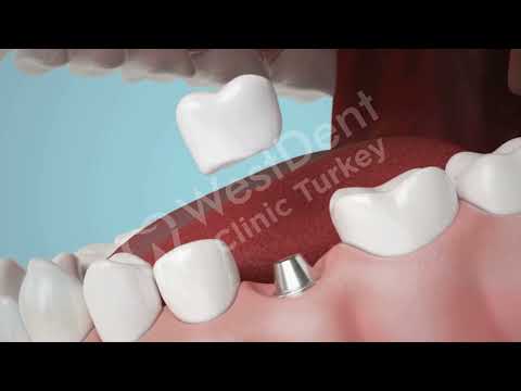Logo of Precision Single Tooth Dental Implant Procedure in Izmir, Turkey