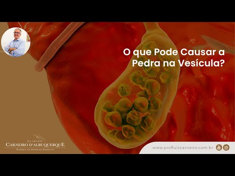 What Causes Gallstones? | Prof. Dr. Luiz Carneiro CRM 22761