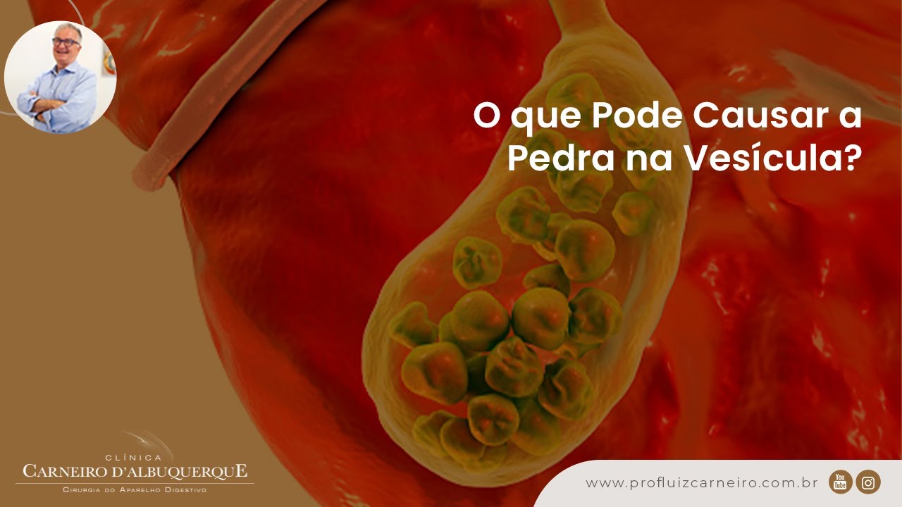 O que Causa Pedra na Vesícula? | Prof. Dr. Luiz Carneiro CRM 22761
