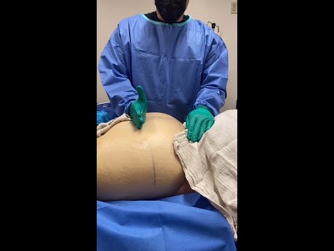 Lipedema Reduction Surgery on the Buttocks area