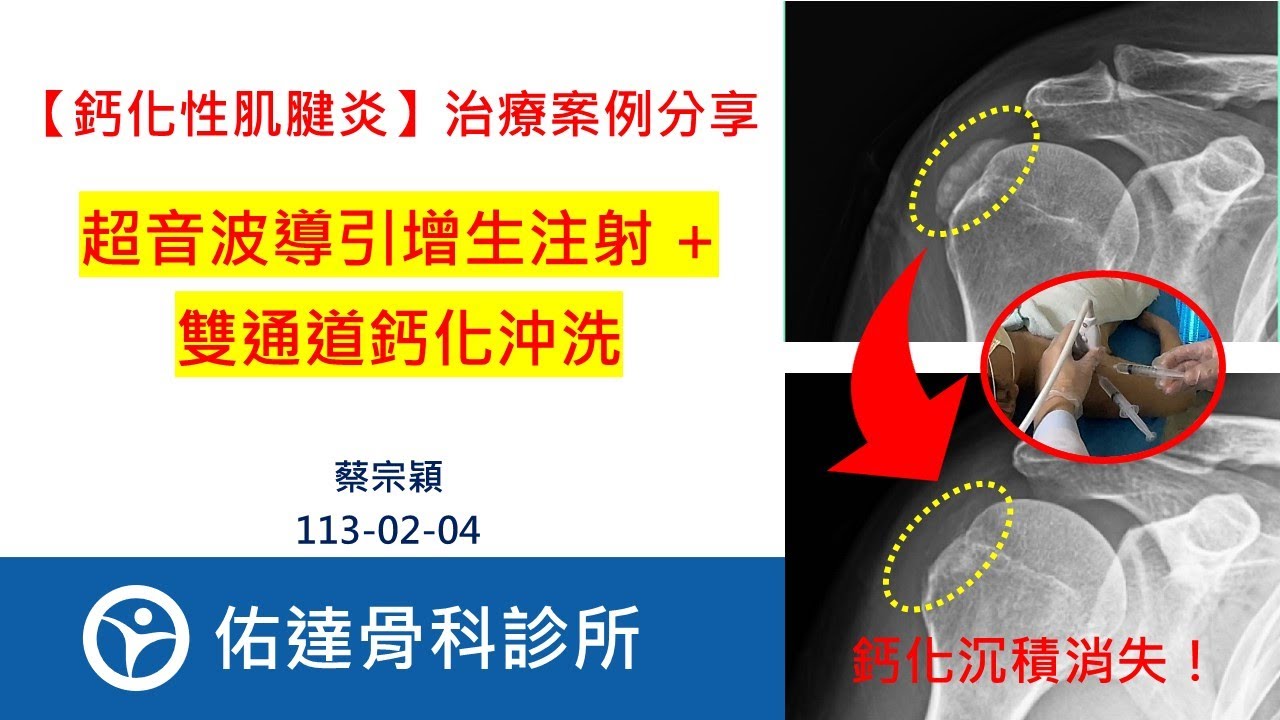 【鈣化性肌腱炎】急性肩膀疼痛、肩痛到舉不起來、Calcific Tendinitis、超音波導引增生注射、雙通道鈣化沖洗、鈣化結晶抽吸【佑達骨科】【蔡宗穎醫師】 - AI健康醫療影片