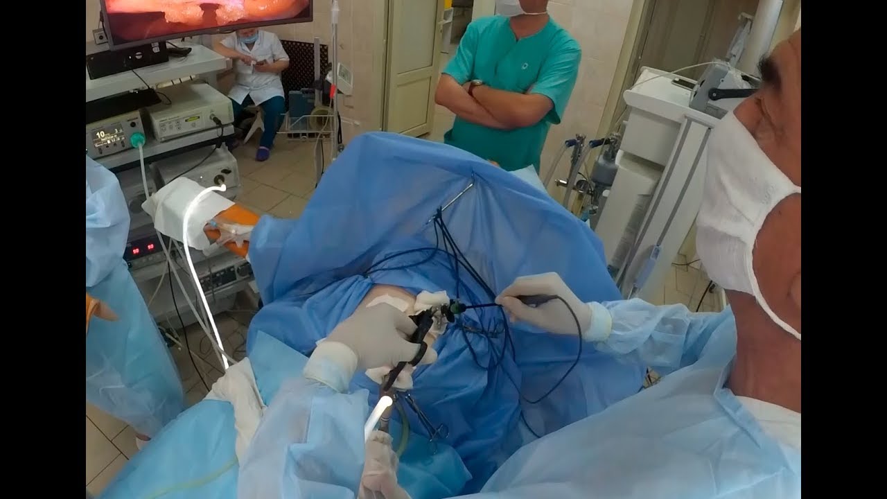 Превью видео на тему Лапароскопия