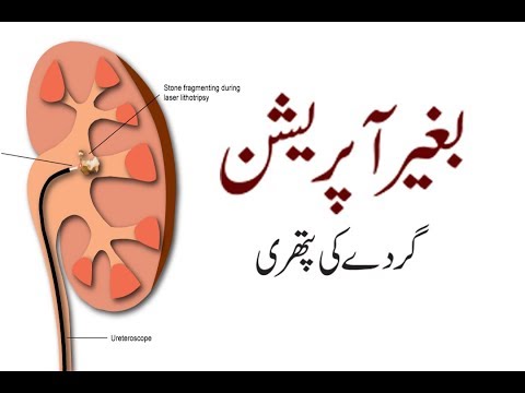 Gurde ki pathri ka ilaj in urdu/hindi