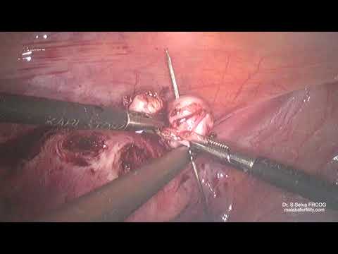 Laparoscopy - How not to loose a fibroid during laparoscopic myomectomy: Stringing the fibroids