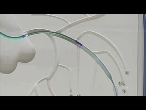 Angioplasty technique: Guide extension catheter