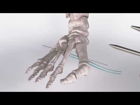 CyclaPlex Surgical animation - Minimal invasive Non Osteotomy bunion correction surgical animation