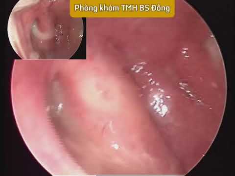 Khám bệnh TMH bằng nội soi