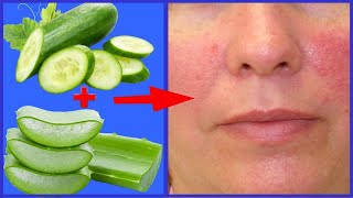 How To Get Rid of Redness on Your Face Fast With Cucumber and Aloe Vera