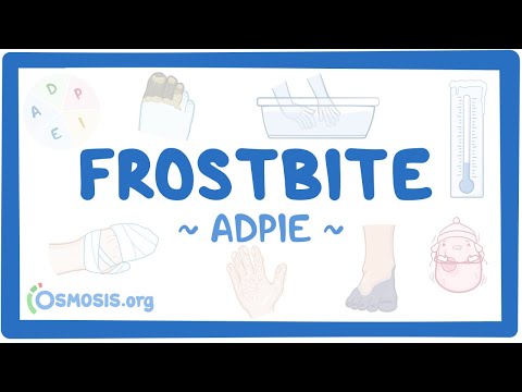 Frostbite: Nursing Process (ADPIE)
