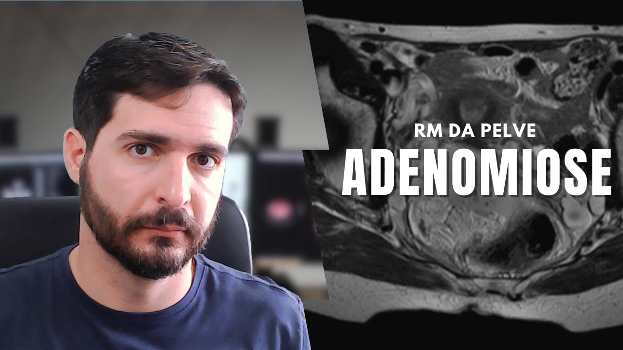 Existe endometriose no útero? Sim, chama-se adenomiose! | Galvani Filho