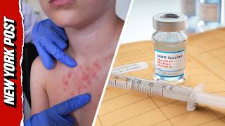 Measles Outbreak Takes Deadly Turn as Pennsylvania Reports First U.S. Deaths