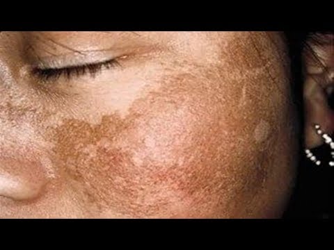 download Cara Alami Memutihkan Wajah Dan Menghilangkan Flek Hitam Dengan Cepat, download video viral Cara Alami Memutihkan Wajah Dan Menghilangkan Flek Hitam Dengan Cepat gratis, unduh video klip Cara Alami Memutihkan Wajah Dan Menghilangkan Flek Hitam Dengan Cepat