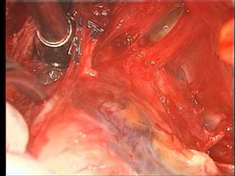 Radical Retropubic Prostatectomy - Open Technique