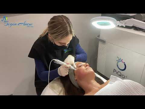 Microneedling at Begin Anew