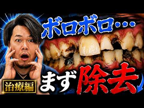【治療編】ボロボロ‥まず除去