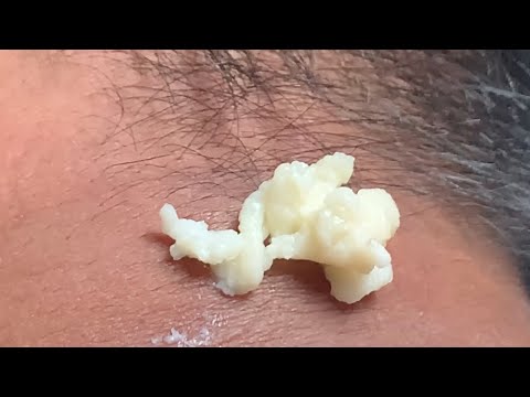 Epic Cyst Popping on the Neck