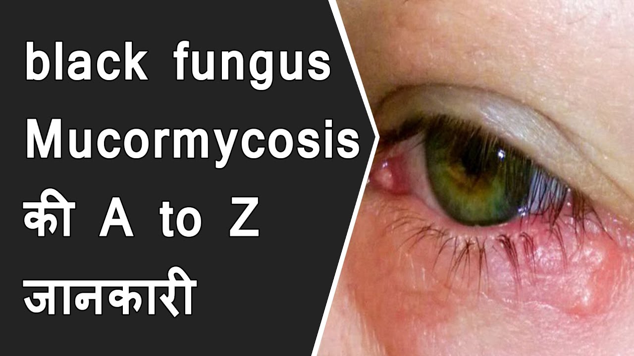 black fungus & Mucormycosis : symptoms and prevention of mucormycosis in covid patients