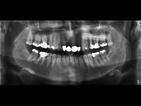 beurteilung des panorama röntgens OPTG