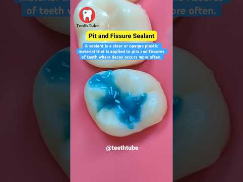 Pit and Fissure Sealant #shorts