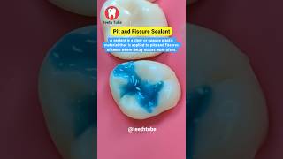 Pit and Fissure Sealant #shorts