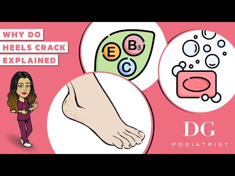 Why do heels crack? Cracked heels treatment series | The Foot Scraper: DG Podiatrist