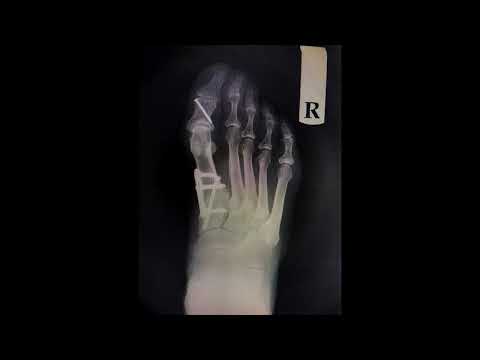 Lapidus vs Syndesmosis bunionectomies: a review by a patient who had both.