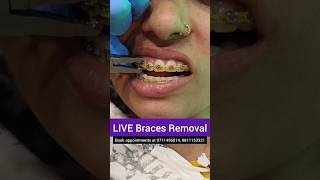 LIVE Braces Removal- Debonding; Dr. Srishti Bhatia #braces #teeth