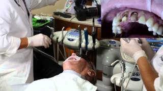 Part 1. Removal of Anterior PFM Crowns |4K Ultra HD|