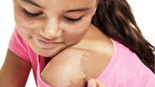 How to Get Rid of Peeling Skin after Sunburn