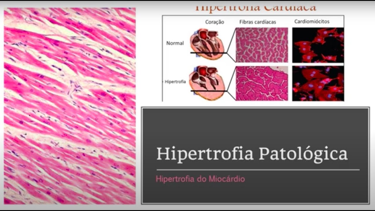 Hipertrofia / Atrofia - Patologia