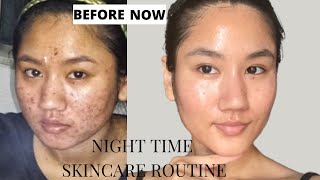 Summer Nighttime skin care routine | Oily & Acne-prone skin |