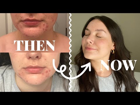 TRETINOIN RESULTS & TIPS + my before and after photos (2 years difference)