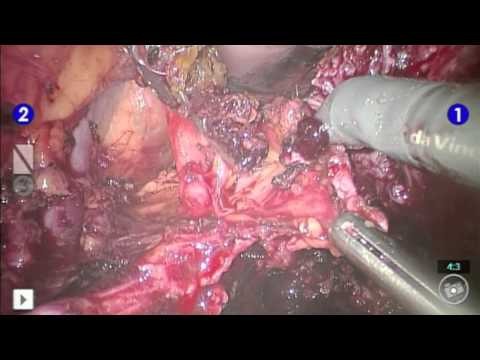 Robotic Hysterectomy with Stage IV Endometriosis